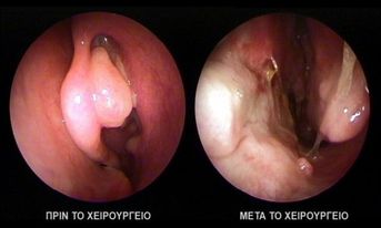 ΑΦΑΙΡΕΣΗ ΠΟΛΥΠΟΔΩΝ ΡΙΝΟΣ