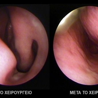ΔΙΟΡΘΩΣΗ ΣΚΟΛΙΩΣΗΣ ΡΙΝΙΚΟΥ ΔΙΑΦΡΑΓΜΑΤΟΣ