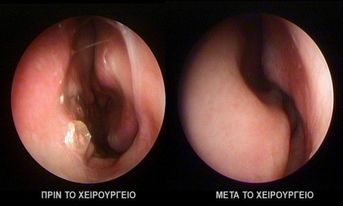 ΔΙΟΡΘΩΣΗ ΣΚΟΛΙΩΣΗΣ ΡΙΝΙΚΟΥ ΔΙΑΦΡΑΓΜΑΤΟΣ