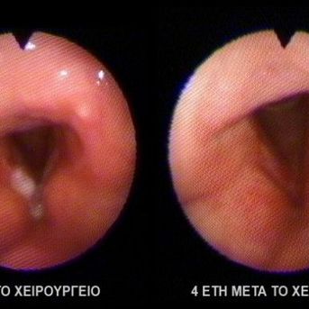 ΚΑΚΟΗΘΕΙΑ ΦΩΝΗΤΙΚΗΣ ΧΟΡΔΗΣ